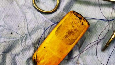Extracting a mobile phone from a patient's stomach