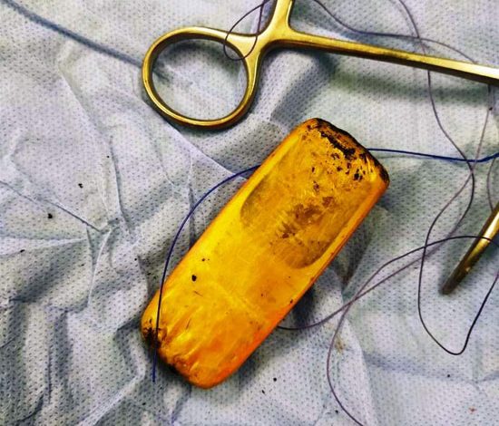 Extracting a mobile phone from a patient's stomach